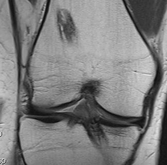 Revision ACL Pre MRI Coronal